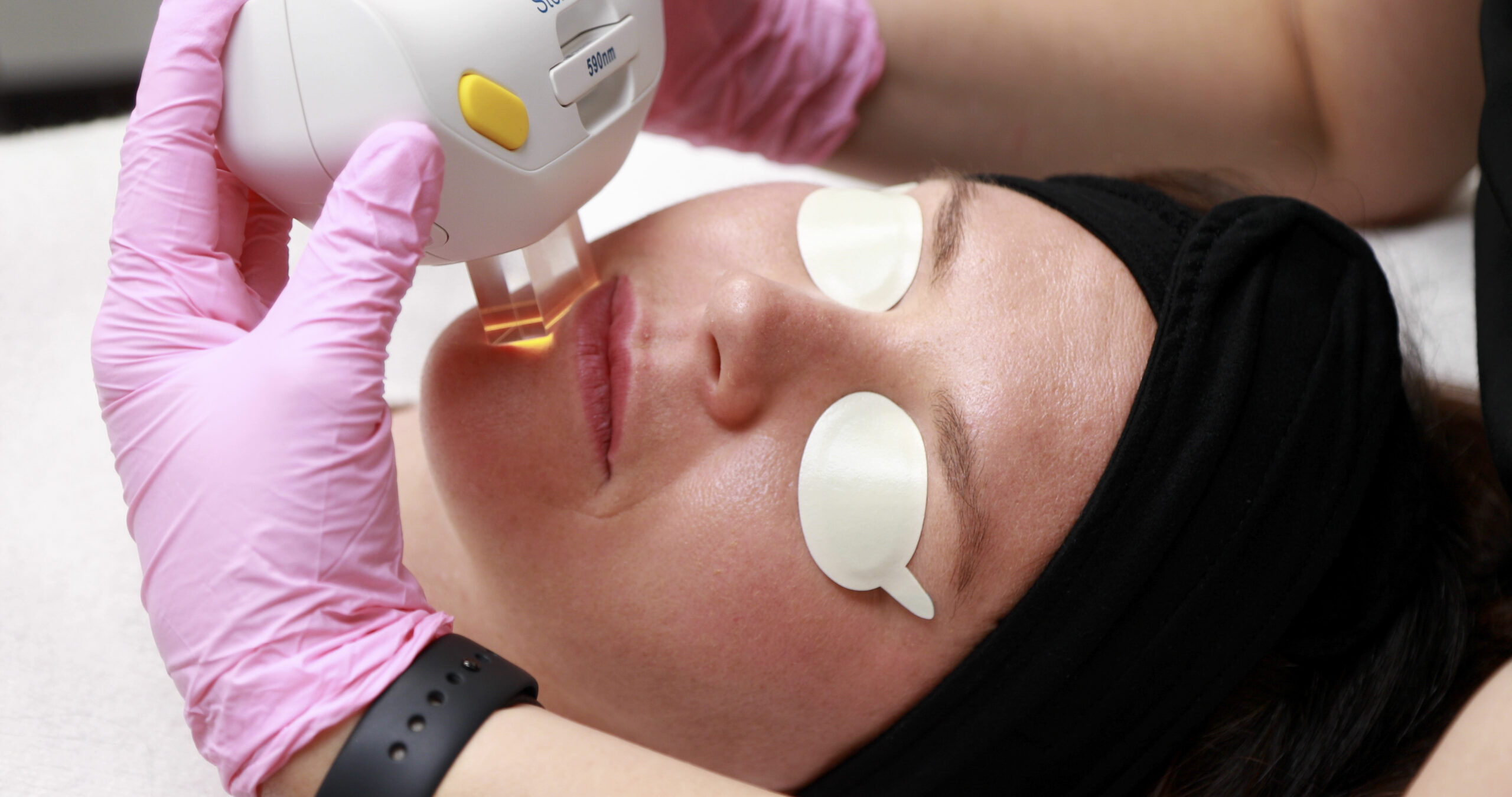 IPL Photorejuvenation